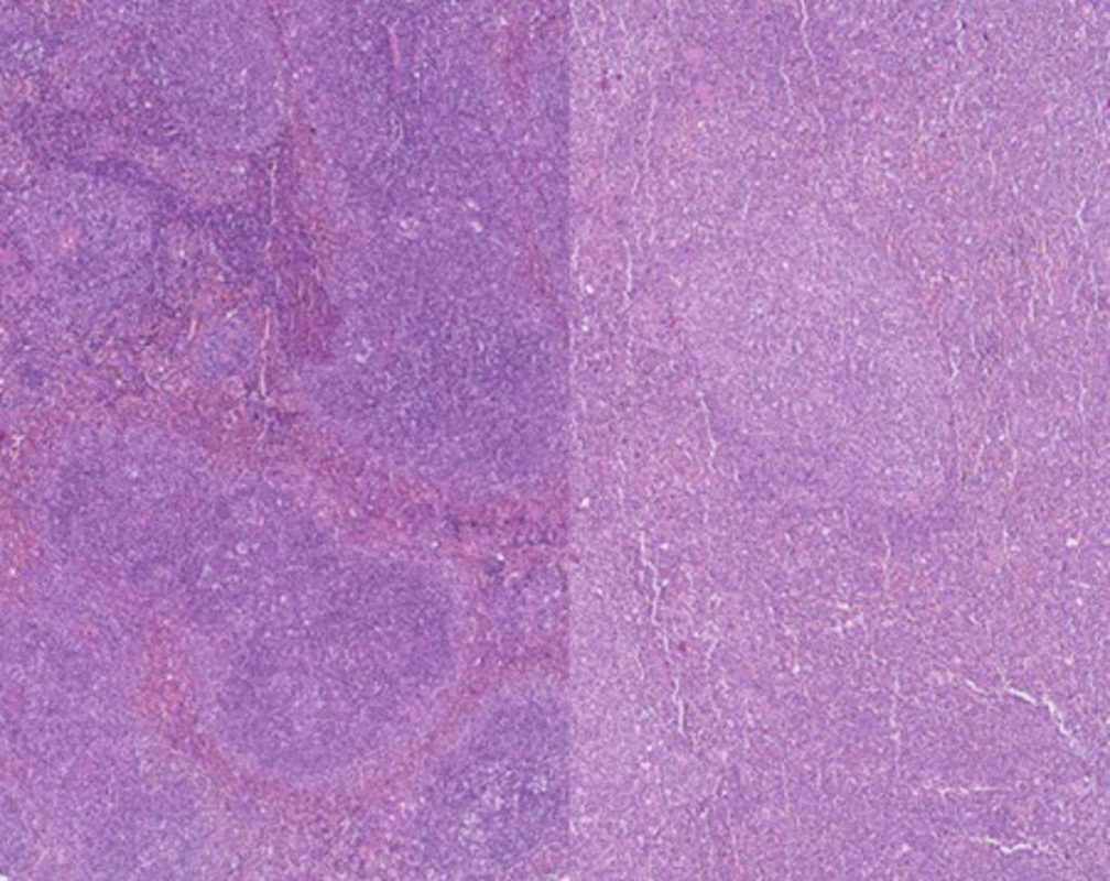 Identifican unos genes que pueden predecir la supervivencia en leucemia mieloide aguda